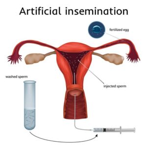 Read more about the article IUI (Intrauterine Insemination)