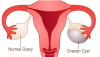 Ovarian Cyst: Types, Causes, and Symptoms 