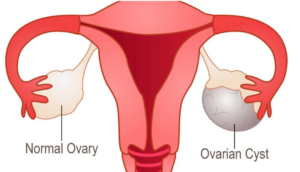 ovarian cyst