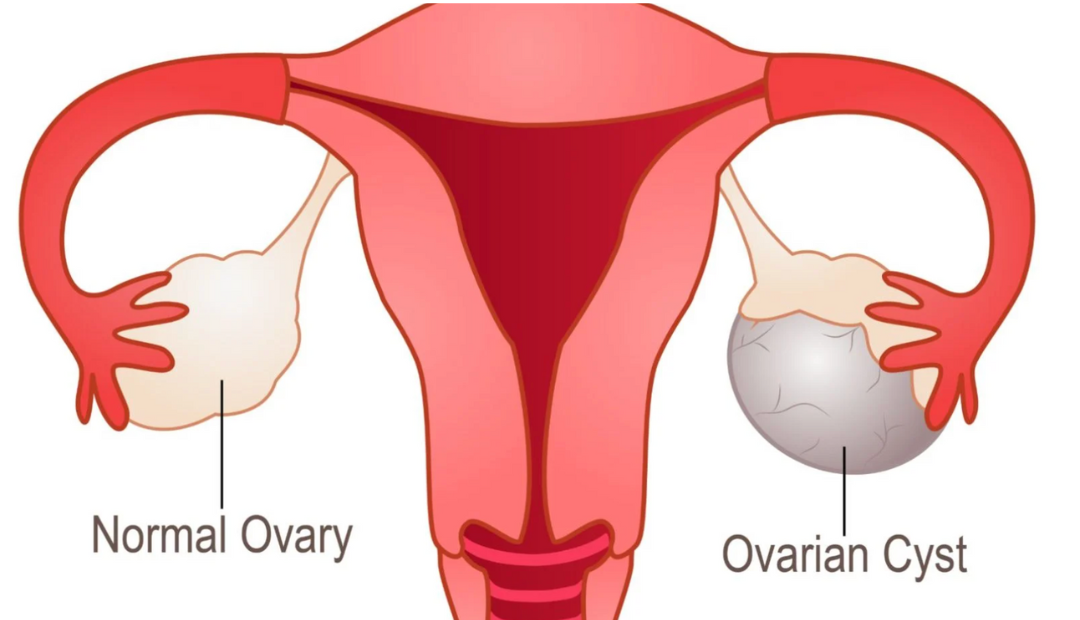 ovarian cyst