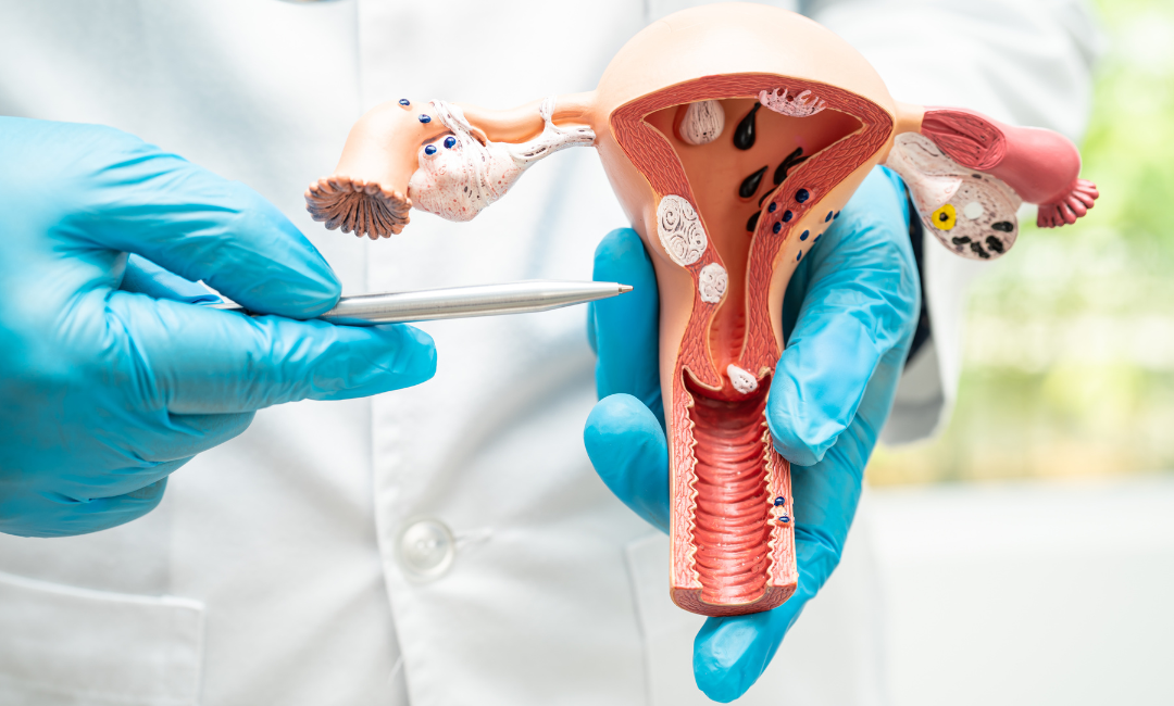 Uterine Fibroids